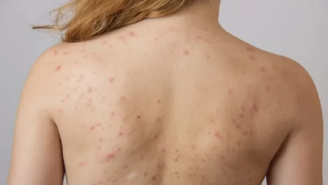 Skin cancer: the signs that should alert you