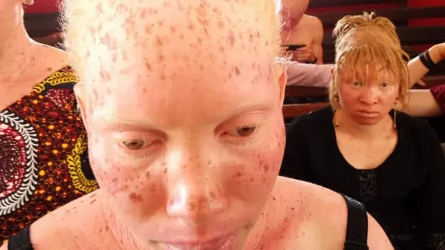 Guinée : dans la peau d’un albinos !