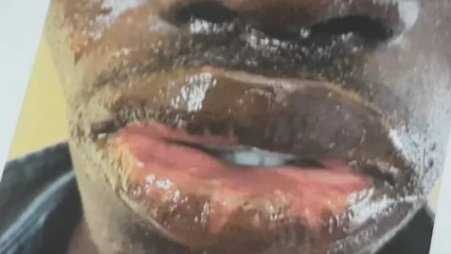 Guinée : plusieurs pêcheurs infectés par une maladie encore inconnue